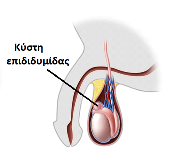 Κύστεις επιδιδυμίδας